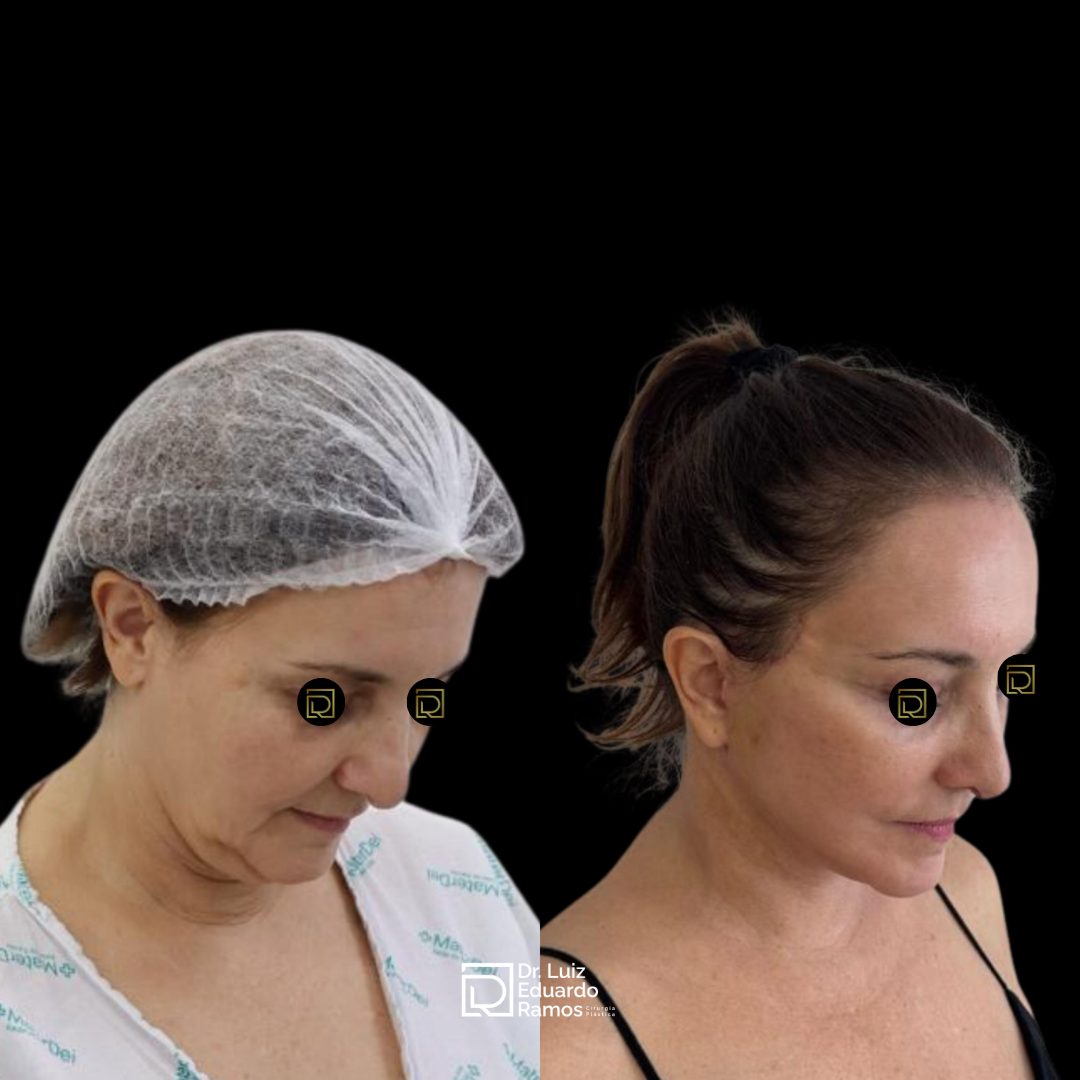Antes e depois de lifting facial — caso 5