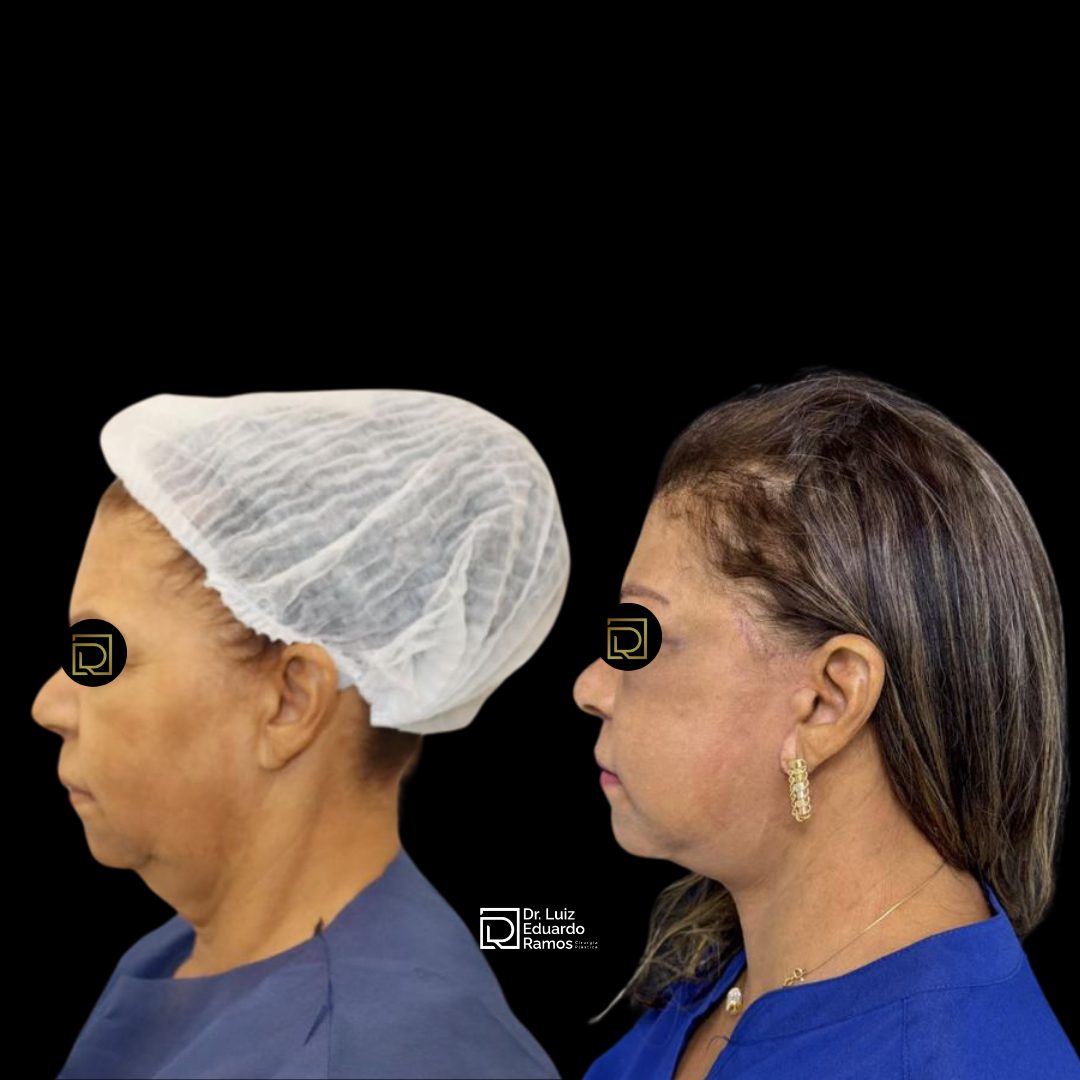 Antes e depois de lifting facial — caso 7