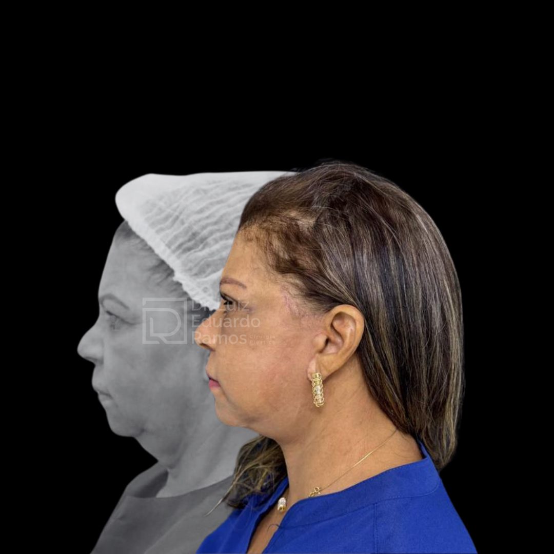 Antes e depois de lifting facial — caso 2