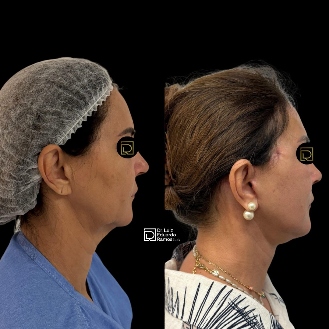Antes e depois de lifting facial — caso 6
