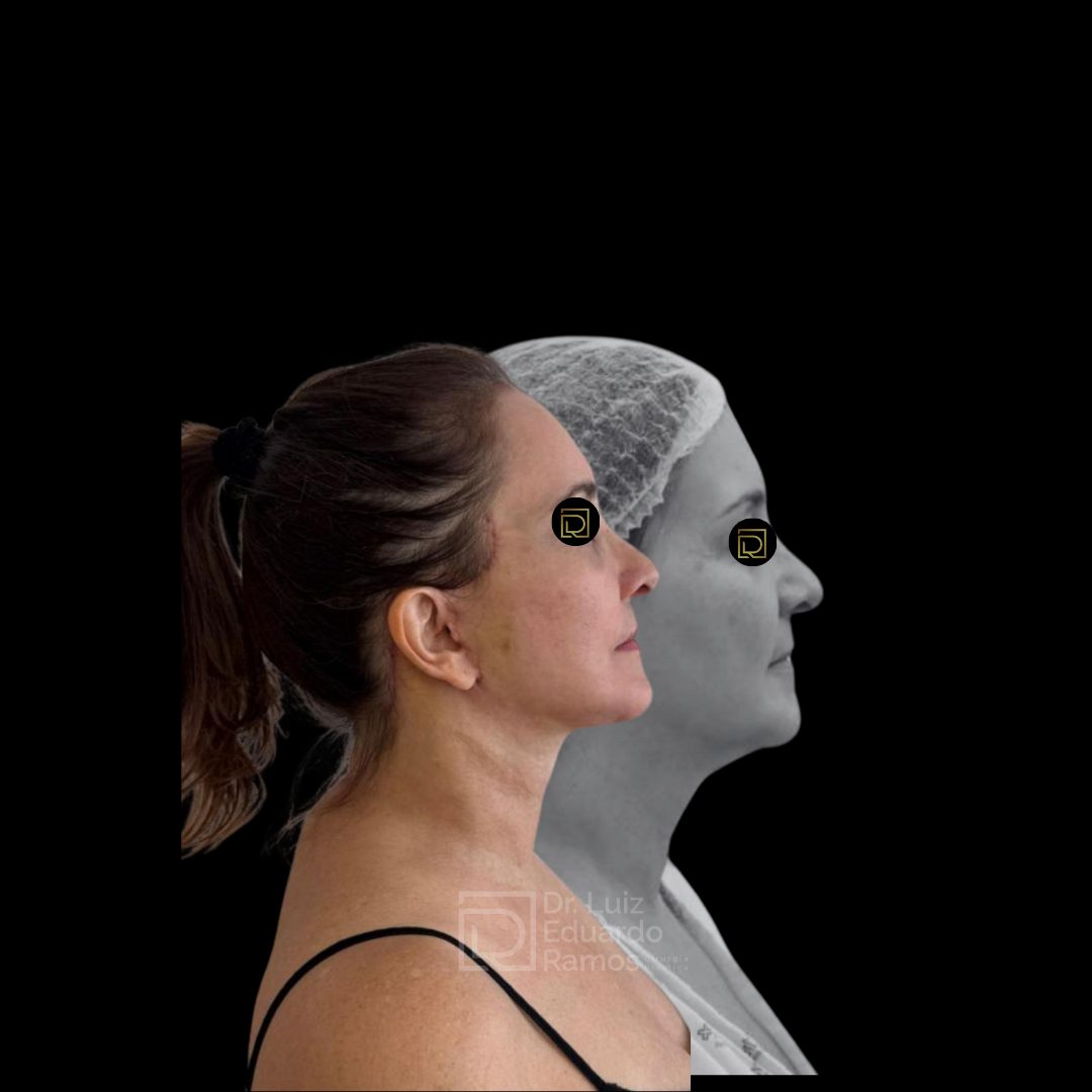Antes e depois de lifting facial — caso 1