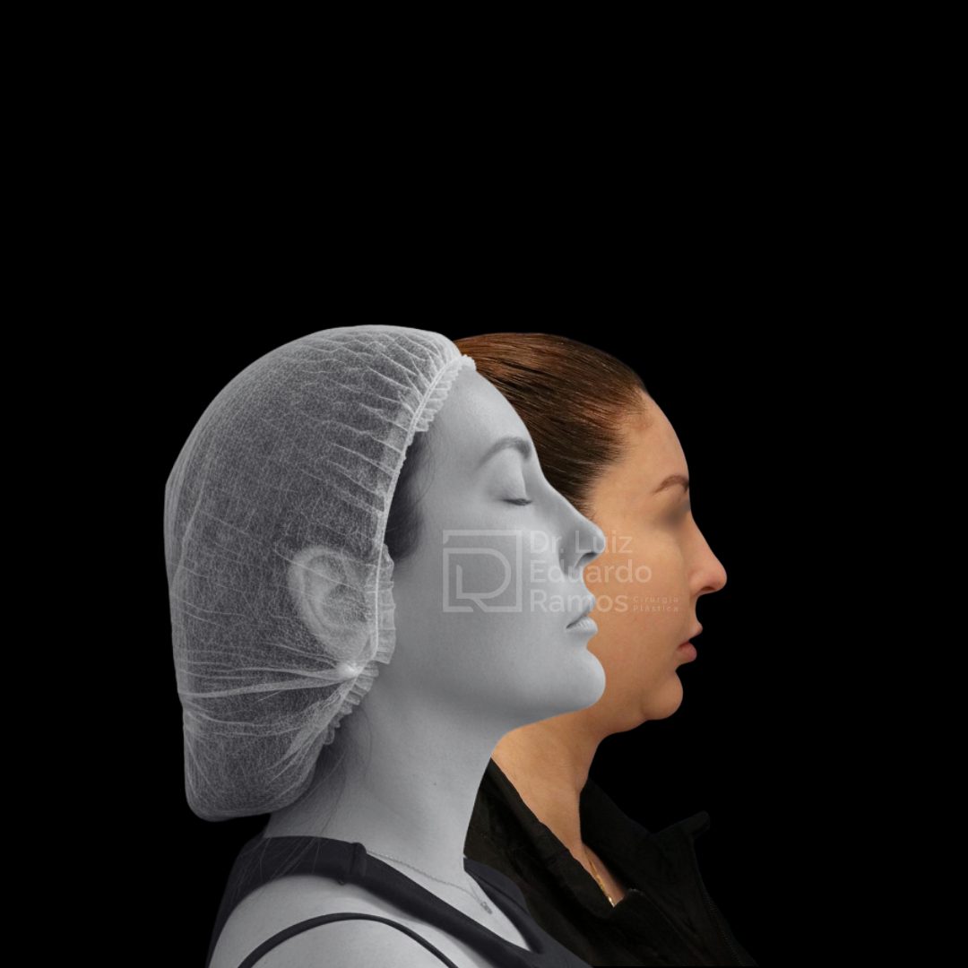 Antes e depois de lifting facial — caso 3