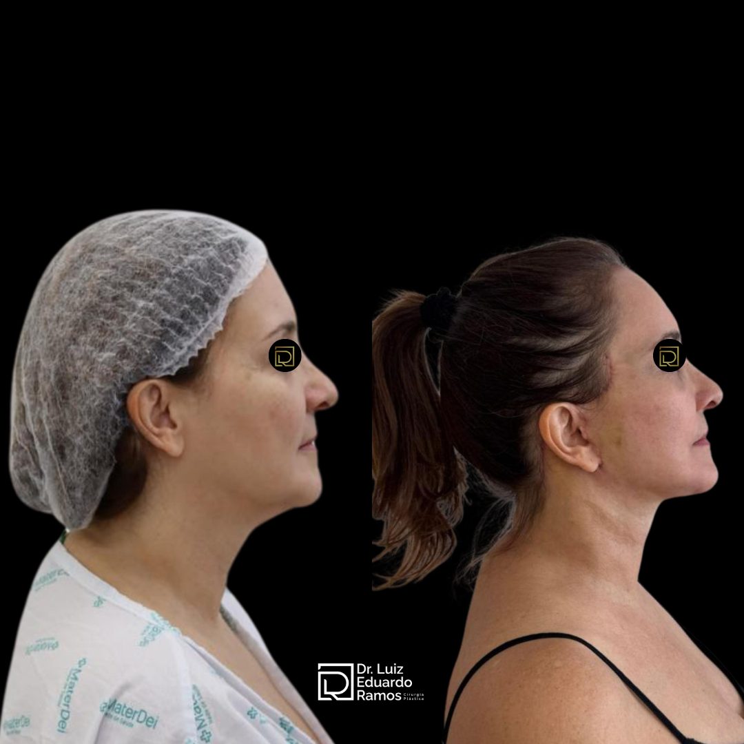 Antes e depois de lifting facial — caso 4